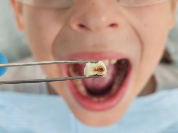 Best Broken or Chipped Tooth Repair in Town Line, NY